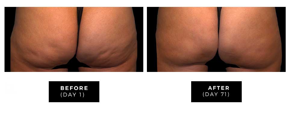 qwo before after soho new york city